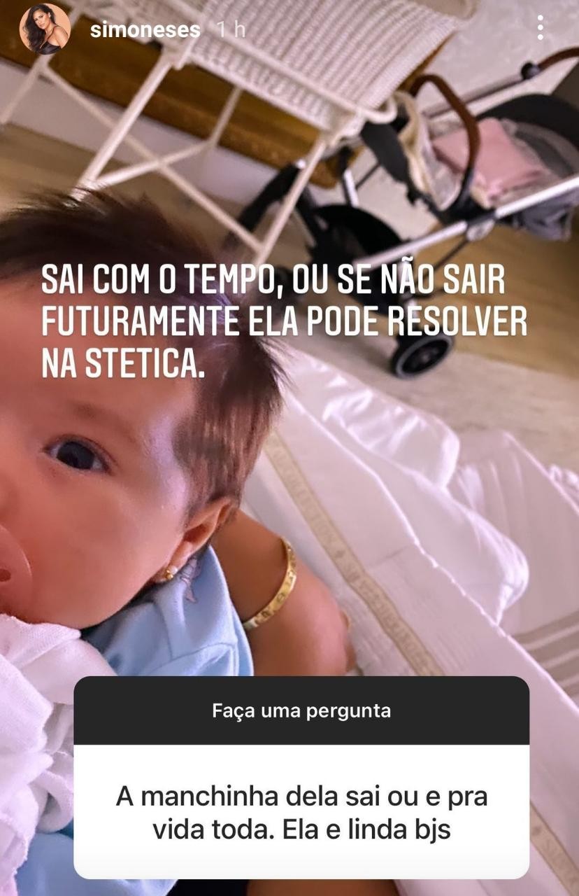 Simone explica mancha no rosto da filha caçula