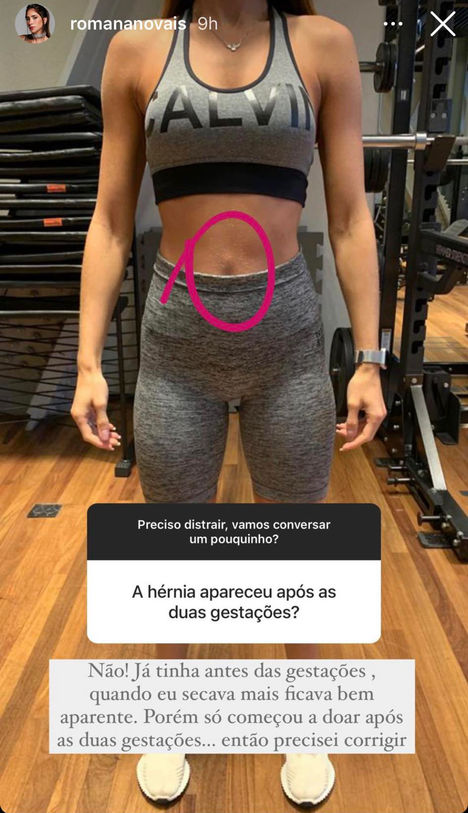 Romana Novais fala sobre cirurgia no abdômen - Crédito: Reprodução / Instagram