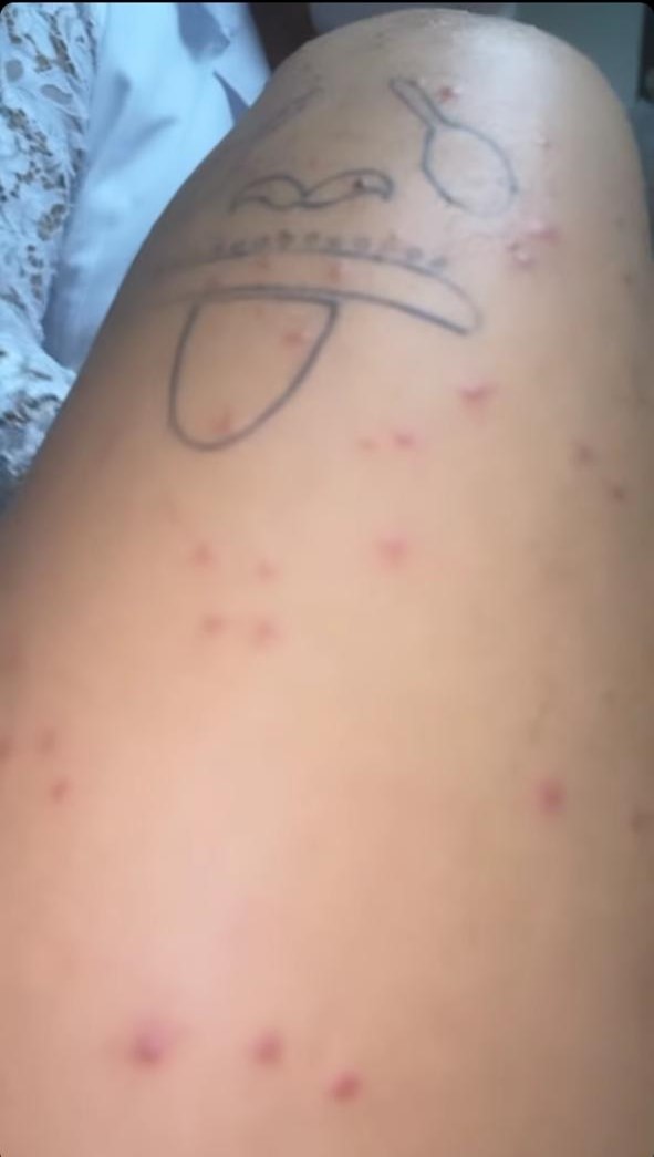 Zé Felipe mostra marcas na pele após ter carrapatos - Crédito: Reprodução / Instagram