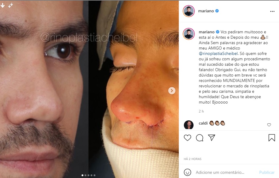 Mariano mostra resultado de procedimento estético. Foto: Reprodução/Instagram