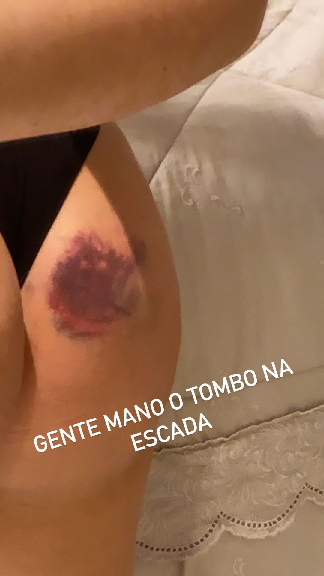 Viih Tube mostra hematoma após queda - Crédito: Reprodução / Instagram