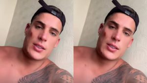 Tiago Ramos aparece machucado após briga. Reprodução/Instagram