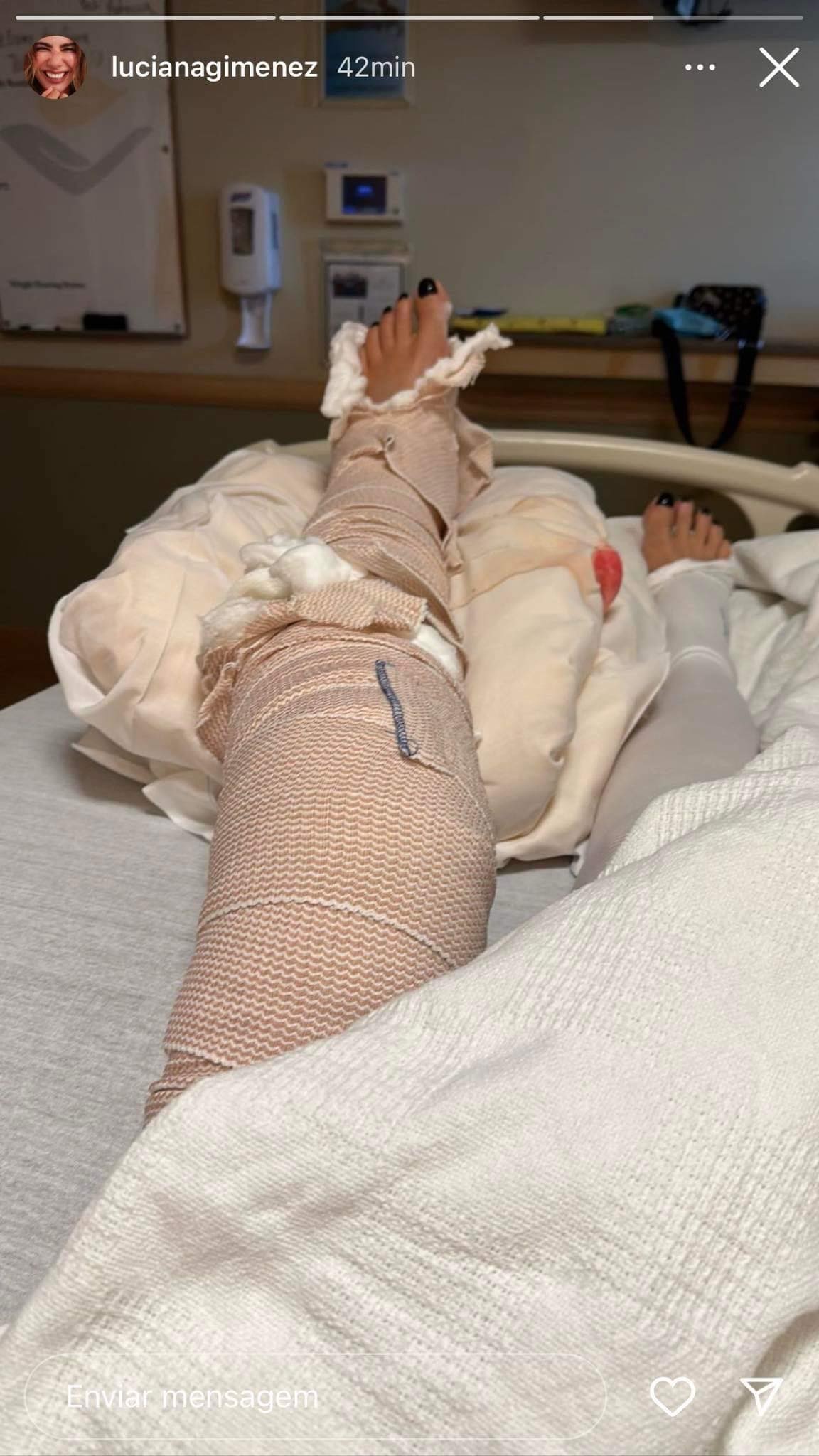Luciana Gimenez mostra perna após cirurgia de emergência (Reprodução/Instagram)