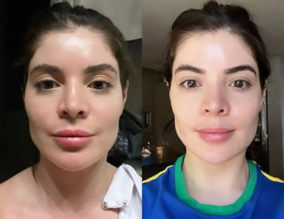 Gkay mostra antes e depois de retirar preenchimento no rosto — Foto: Reprodução/Instagram