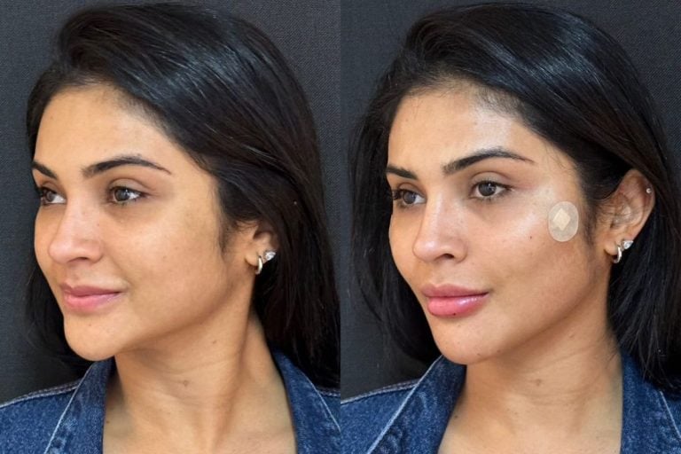 Mileide Mihaile mostra antes e depois de procedimento no rosto
